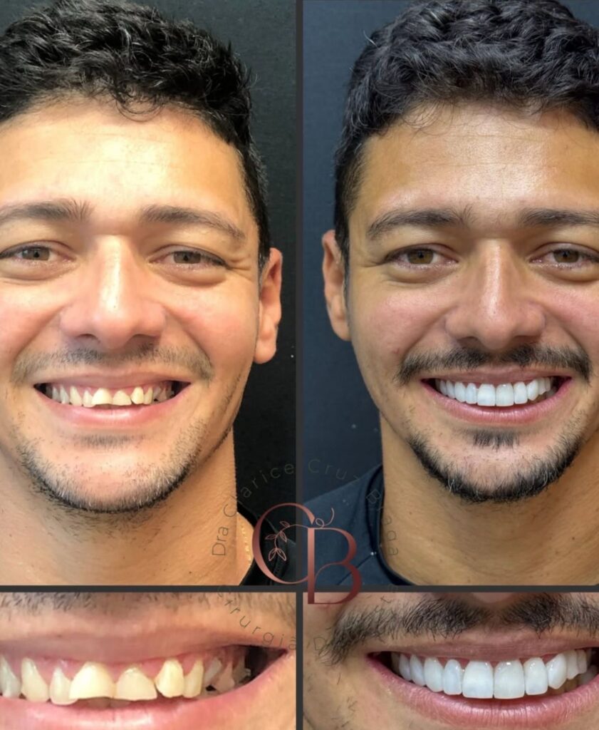Dra. Clarice Cruz Braga: A Arte De Transformar Sorrisos Com Elegância E Naturalidade 1 4822f79d 2721 411f 9bc7 f39fcb6c796b