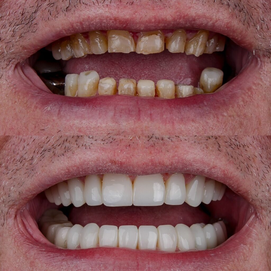 Dr. Júnior Jacomini: Referência Em Lentes De Resina E Implantes Que Já Transformou Mais De 7 Mil Sorrisos No Instituto Do Dente 1 30f61702 dde4 4f4f 915f 7cb26ed554af