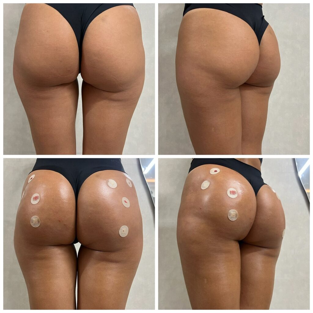 Dra. Camila Melotto: Técnica, Propósito E A Consolidação De Um Método Que Transforma A Harmonização De Glúteos No Brasil 2 3fb61803 2186 4653 84dc 698c9a475256