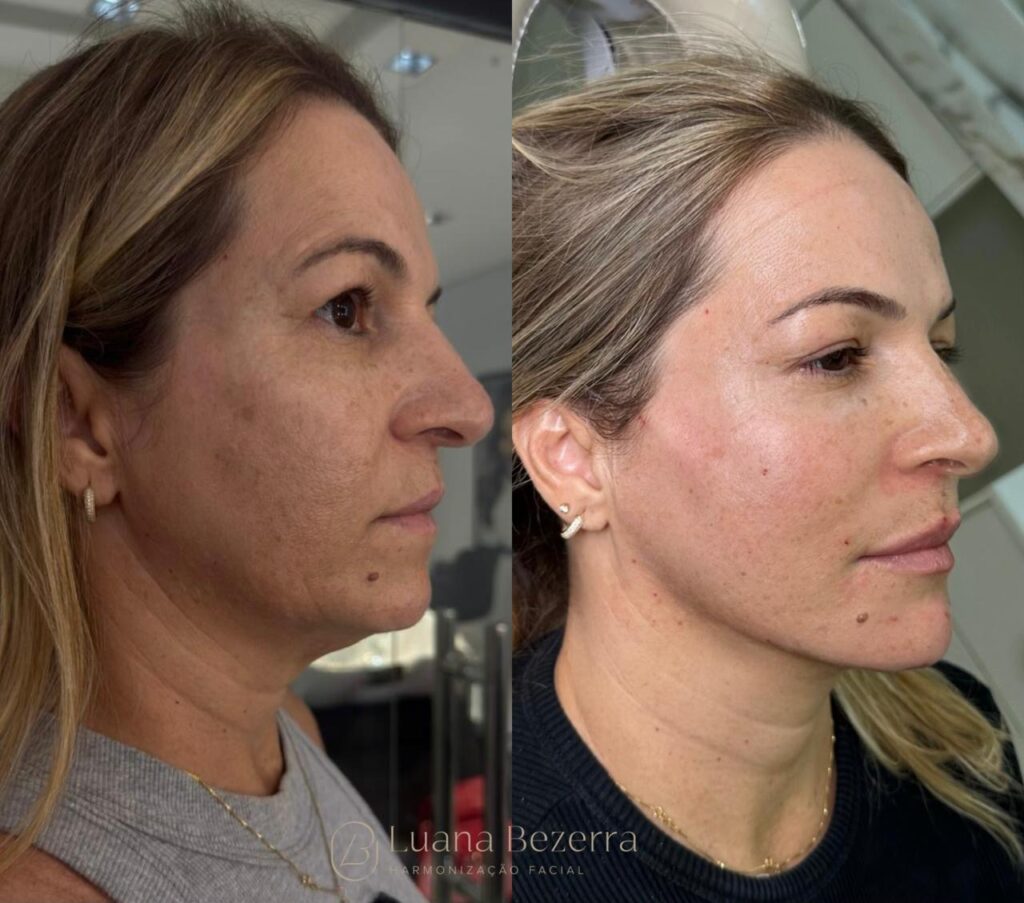 O Novo Padrão Da Harmonização Facial Tem Nome: Dra. Luana Bezerra 3 051dd7d0 3958 4f3f b7aa 5a32ca0b2cf0