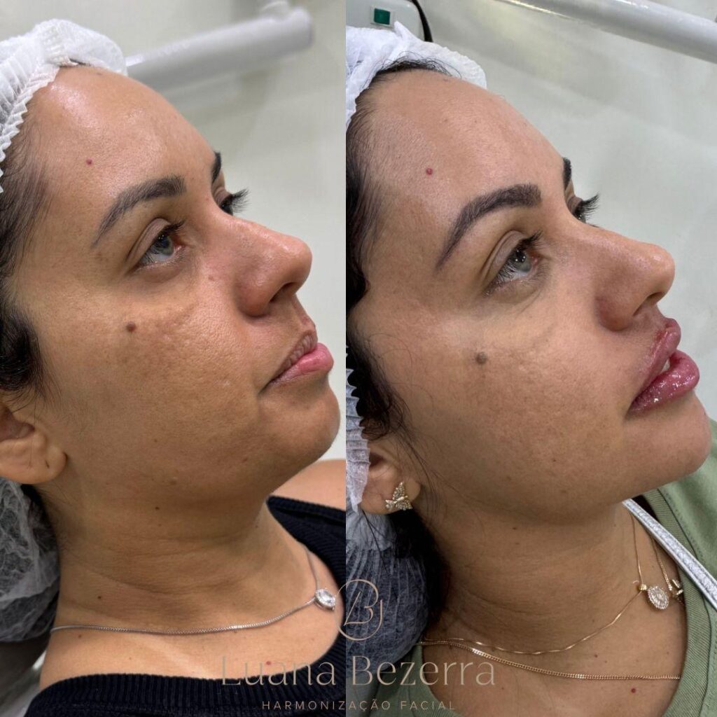 O Novo Padrão Da Harmonização Facial Tem Nome: Dra. Luana Bezerra 1 998740ae 635e 4843 a734 fdd1fdf06a02