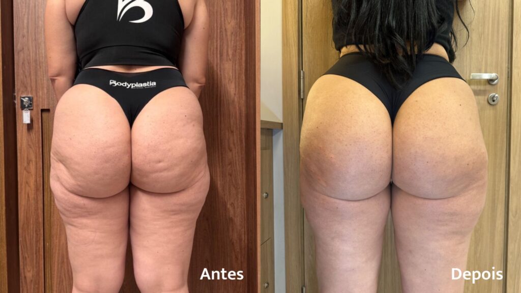 Mulheres, Celulite E O Método Bodyincision: O Que Muda Quando O Tratamento Vai Além Da Superfície 1 PHOTO 2026 05 26 14 35 23