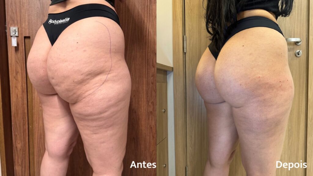 Mulheres, Celulite E O Método Bodyincision: O Que Muda Quando O Tratamento Vai Além Da Superfície 2 PHOTO 2026 05 26 14 35 24